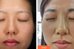 上海鵬愛醫(yī)療美容門診部樊學慧整形價格表附光子嫩膚案例展示