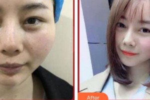 上海宸妃醫(yī)學美容醫(yī)院朱世廣整形價格表附鼻部綜合案例展示