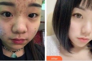 上海天大醫(yī)療美容醫(yī)院張杏整形價格表附點(diǎn)陣激光祛痘印痘坑案例展示