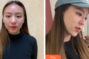 廣州星團(tuán)醫(yī)學(xué)美容門診部田夫整形價(jià)格表附自體肋軟骨隆鼻案例展示