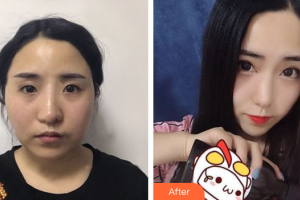 廣州星團(tuán)醫(yī)學(xué)美容門診部張少博整形價(jià)格表附面部吸脂案例展示