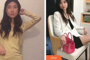 桂林華美醫(yī)療美容門診部趙麗紅整形價格表附玻尿酸導(dǎo)入精華案例展示