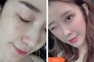 貴陽醫(yī)學(xué)院附屬醫(yī)院燒傷整形外科雷雨整形價格表附鼻部綜合案例展示