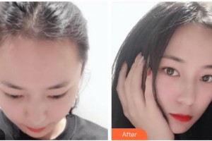 上海曙康口腔門診部康鈞棠整形價格表附發(fā)際線種植案例展示