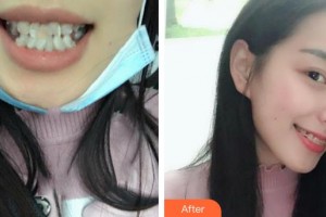 上海雅圣口腔門診部洪允義整形價格表附超聲波潔牙案例展示