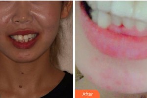 上海市口腔醫(yī)院宋治鋒整形價格表附全隱形牙齒矯正案例展示