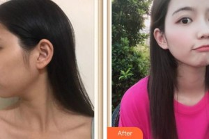 上海氧顏醫(yī)療美容門診部王建麗整形價格表附水氧案例展示