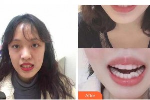上海匯尚口腔門診部高悅整形價格表附全隱形牙齒矯正案例展示