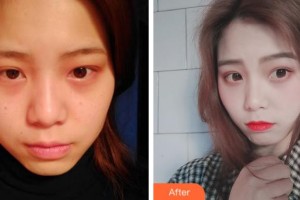 上海福仁眼科門診部王江橋整形價格表附全切雙眼皮案例展示