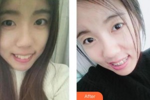 上海永華口腔門診部仇玲整形價格表附牙齒隱形矯正案例展示