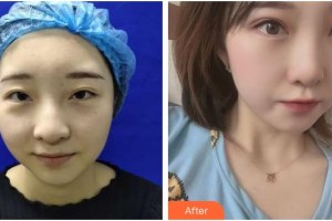 上海希瑪瑞視眼科醫(yī)院張士勝整形價格表附全切雙眼皮+去皮去脂案例展示