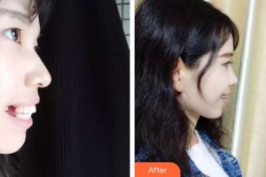 上海拜博昌仁口腔門診部尹琪琪整形價格表附牙齒矯正案例展示