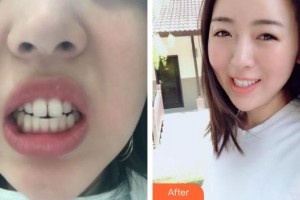 上海維樂口腔門診部沈華整形價格表附門牙擁擠、齙牙案例展示