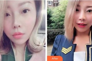 上海摩爾口腔門診部陳建榮整形價格表附牙齒隱形矯正案例展示