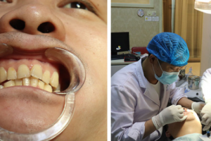 南京智顏醫(yī)療美容門診部高仲岳整形價格表附激光祛斑案例展示