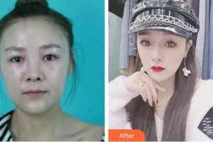 上海容妍醫(yī)療美容門診部袁鹿整形價格表附面包臉到鴨蛋臉變形記案例展示