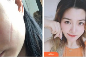 上海明珠醫(yī)院整形美容中心崔春雷整形價格表附手術(shù)祛疤案例展示