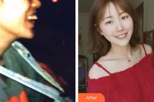 上海華美醫(yī)療美容醫(yī)院姚廣楠整形價格表附隱形托槽矯正案例展示