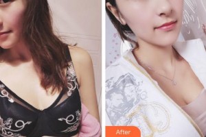 上海明珠醫(yī)院整形美容中心張東旭整形價格表附濃縮豐胸真實案例展示