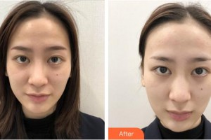 上海新形象整形外科門診部張桂蓉整形價格表附點陣激光案例展示