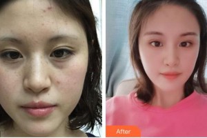 上海御顏醫(yī)療美容門診部張偉整形價格表附祛斑案例展示