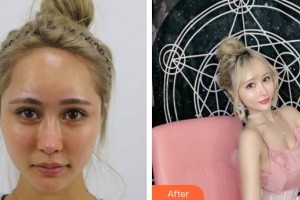 上海南山醫(yī)院美容外科王虎軍整形價格表附酒窩案例展示