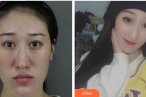 上海南山醫(yī)院美容外科盧立新整形價格表附神奇的雙顎畸形矯正術(shù)案例展示