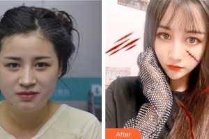 上海南山醫(yī)院美容外科韓立志整形價格表附面部光纖案例展示