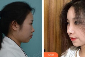 上海麗園醫(yī)療美容門診部陳海珍整形價格表附鼻部手術(shù)|打造精致自然翹鼻案例展示