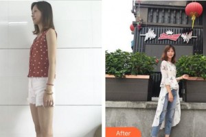 上海麗園醫(yī)療美容門診部潘偉整形價格表附燙傷疤痕案例展示