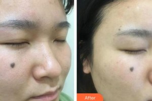 上海麗質(zhì)整形美容醫(yī)院胡彩艷整形價格表附毛孔粗大案例展示