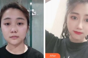 上海麗質(zhì)整形美容醫(yī)院史正忠整形價格表附肋軟骨隆鼻案例展示