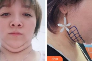 上海麗質(zhì)整形美容醫(yī)院高冠云整形價格表附面部輪廓案例展示