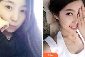 上海知音醫(yī)院醫(yī)療美容科姬瑩瑩整形價格表附牙齒矯正案例展示