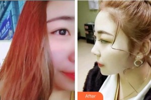 上海知音醫(yī)院醫(yī)療美容科韓沒問題整形價格表附超聲波潔牙案例展示