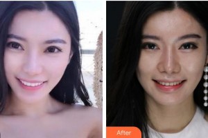 上海知音醫(yī)院醫(yī)療美容科祝桂祥整形價格表附瓷貼面案例展示