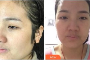 上海鷗美藥妝醫(yī)療美容門診部翁秀麗整形價格表附超激光美膚祛斑案例展示