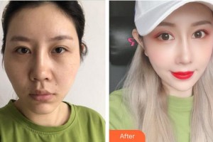 上海馨美醫(yī)療美容門診部錢鋆整形價格表附面部吸脂案例展示