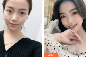 上海昕伊顏醫(yī)療美容醫(yī)院吳躍整形價格表附切開雙眼皮+內(nèi)眼角案例展示