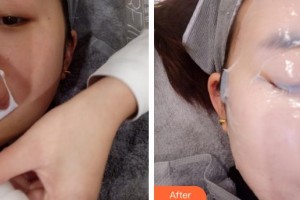 上海歐萊美醫(yī)療美容醫(yī)院南承喜整形價格表附光子嫩膚案例展示