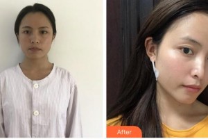 上海歐萊美醫(yī)療美容醫(yī)院楊書彬整形價格表附面部吸脂案例展示