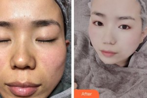 上海麗鉑醫(yī)療美容門診部蕭名棋整形價格表附超激光美膚祛斑案例展示