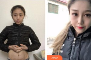 上海麗鉑醫(yī)療美容門診部丁奕如整形價格表附妊娠紋案例展示