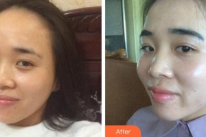 上海潔銘醫(yī)療美容門診部鄭志成整形價格表附光子嫩膚案例展示