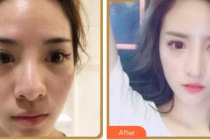 上海微藍(lán)醫(yī)療美容門診部鄭珉在整形價格表附鼻部多項案例展示