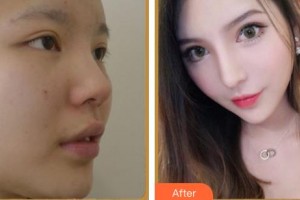 上海微藍(lán)醫(yī)療美容門診部鐘國平整形價格表附鼻部綜合案例展示