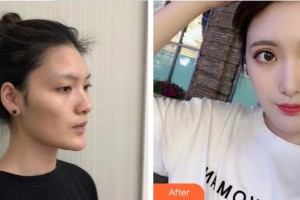 上海韓鏡醫(yī)療美容醫(yī)院趙越整形價格表附自體脂肪填充額頭案例展示