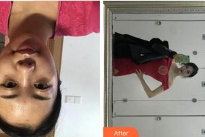 上海韓鏡醫(yī)療美容醫(yī)院尹弘錫整形價格表附點陣激光案例展示