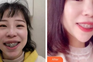 上海永華口腔門診部李耀華整形價(jià)格表附瓷貼面案例展示