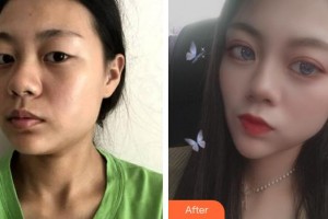 上海維樂口腔門診部柯良騏整形價(jià)格表附下頜角整形案例展示